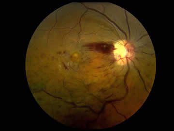 Retinal Ven Dal Tıkanıklığı