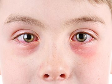 Göz Alerjisinin Nedenleri ve Tedavisi