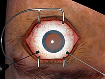 Retina Ameliyatı Öncesinde ve Sonrasında Bilinmesi Gerekenler