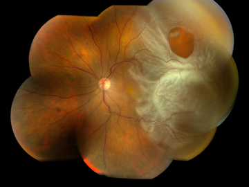 Retina Dekolmanı (Retina Ayrılması) Hakkında Doğru Bilinen 10 Yanlış