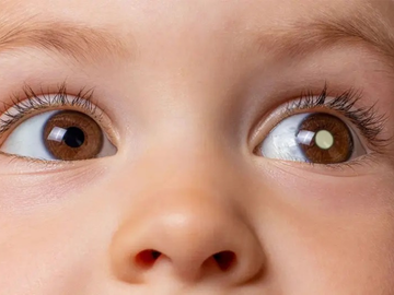 Retinoblastom