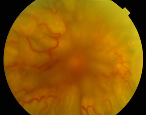 agir-proliferatif-retinopati