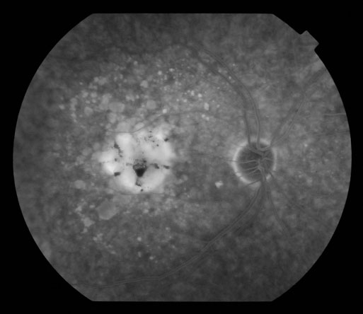 Fundus Floresein Anjiyografisi